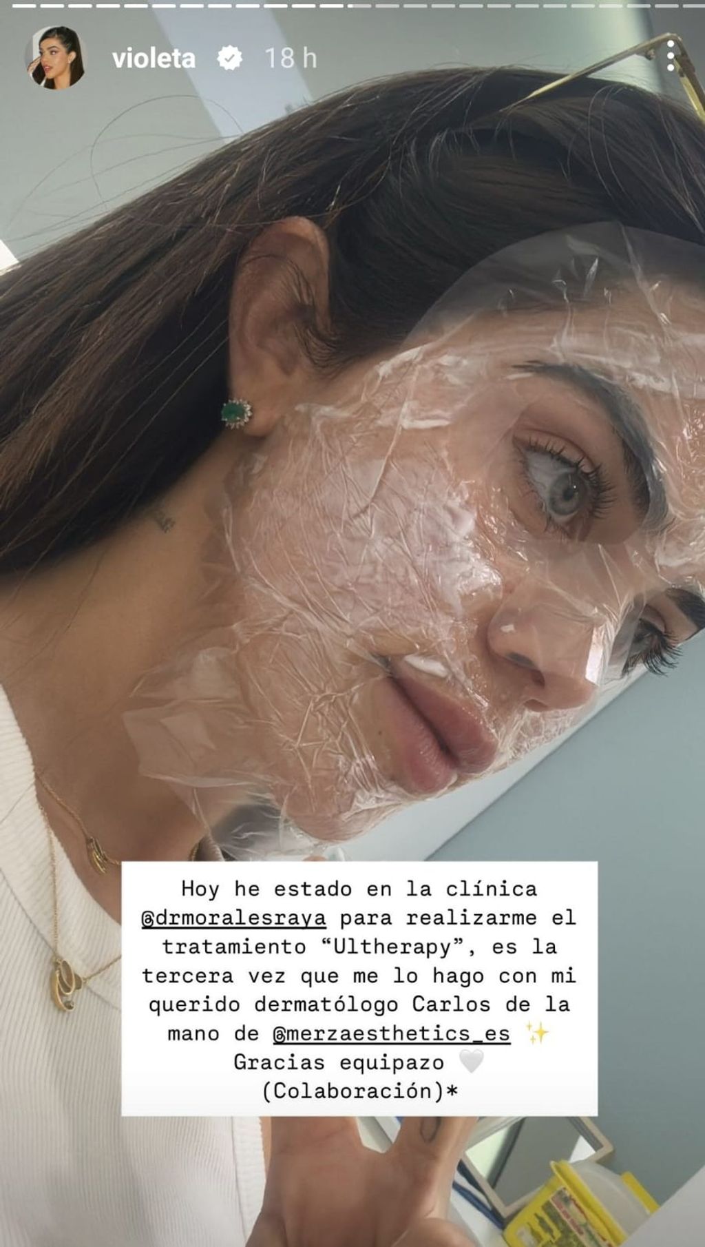 Violeta Mangriñán, en el tratamiento 'Ultherapy'