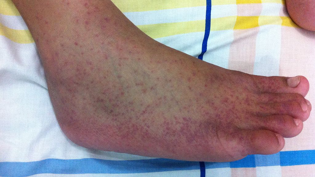 Chikungunya3
