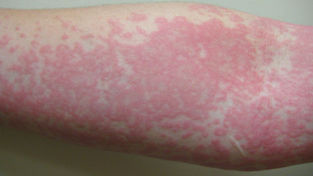 urticaria