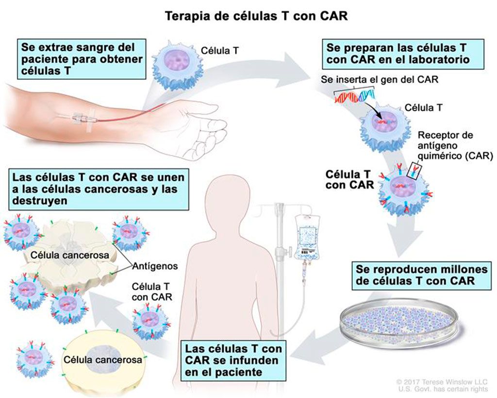 Esquema del funcionamiento de las terapias CAR-T