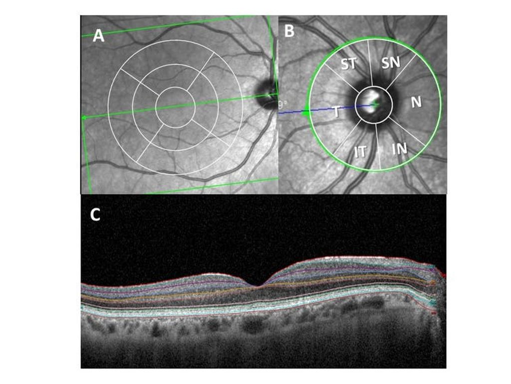 Examen de la retina con tomografía