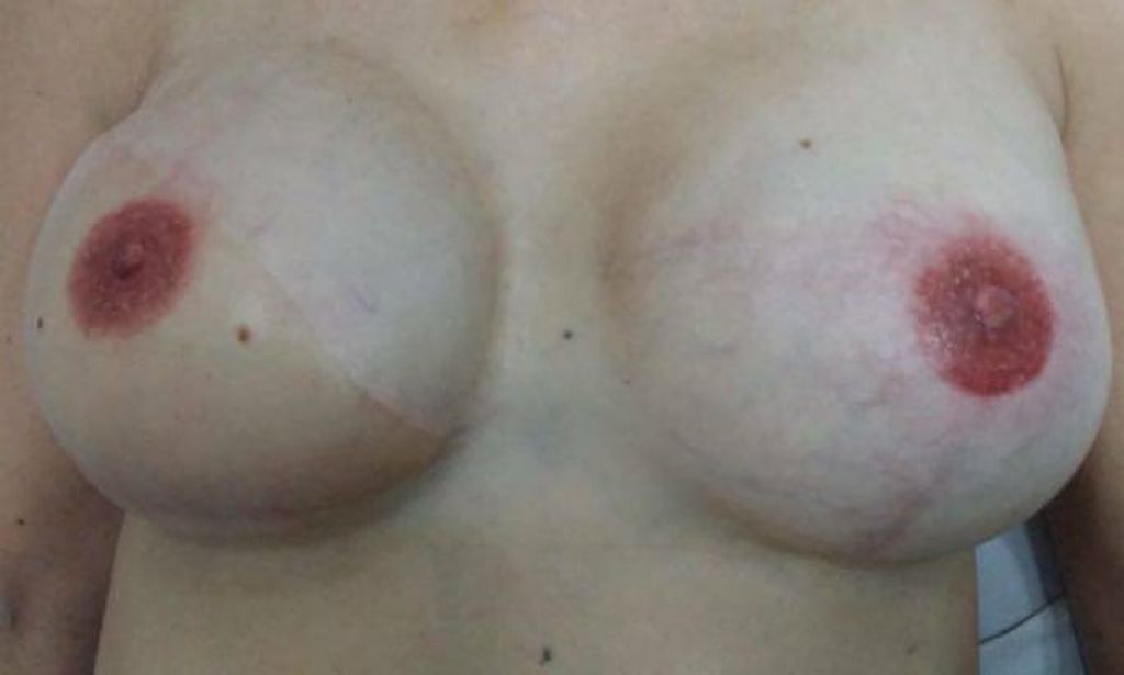 Pechos tras el tatuaje