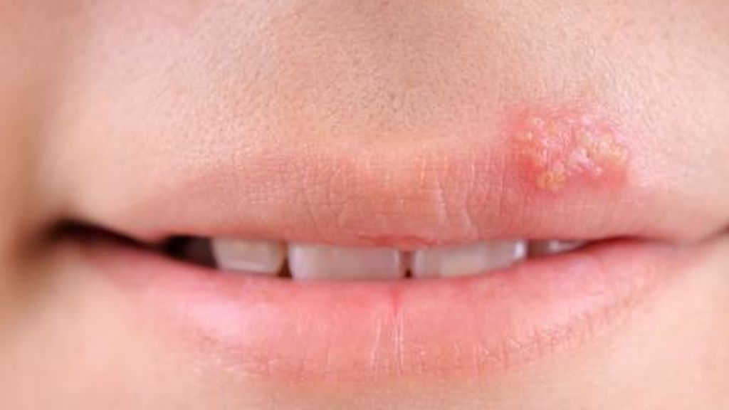 El impétigo es una infección que suele afectar a la zona de la cara, como a la boca.