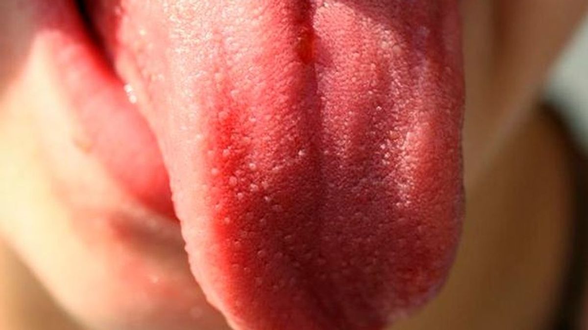 El sarpullido en la boca, otro síntoma del coronavirus que se une a la lista