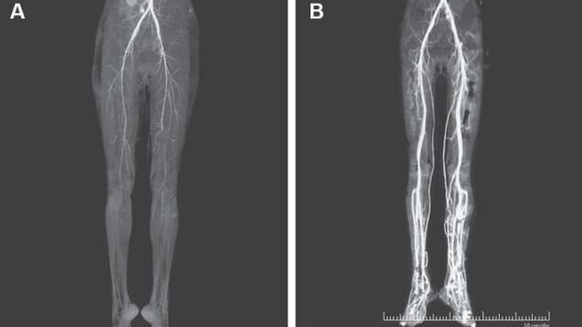 Diagnostican a una mujer que sufre dolores abrasadores en las piernas con la enfermedad medieval del "fuego sagrado" Diagnostican a una mujer que sufre dolores abrasadores en las piernas con la enfermedad medieval del "fuego sagrado"