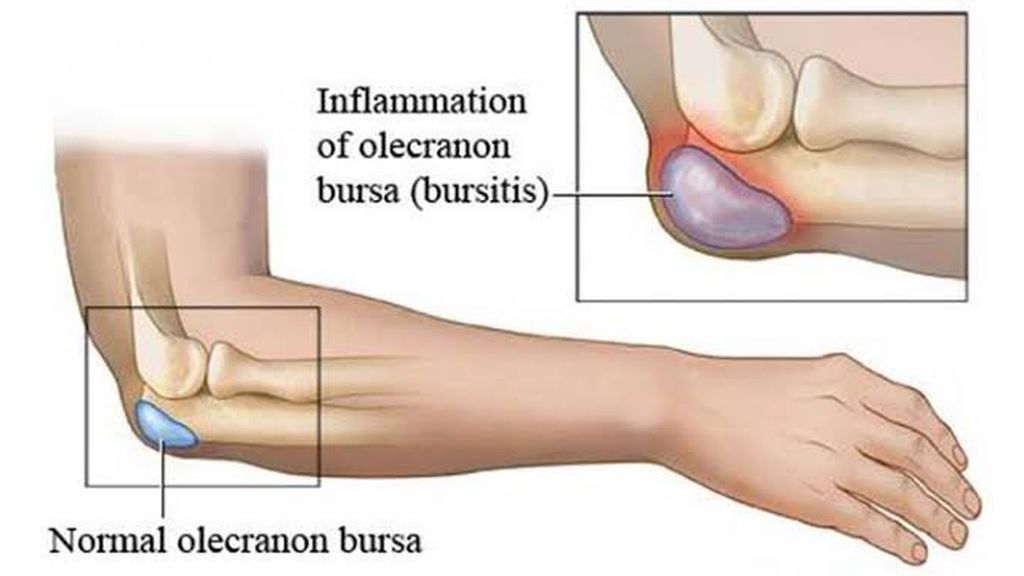 radiografía de la bursa del codo