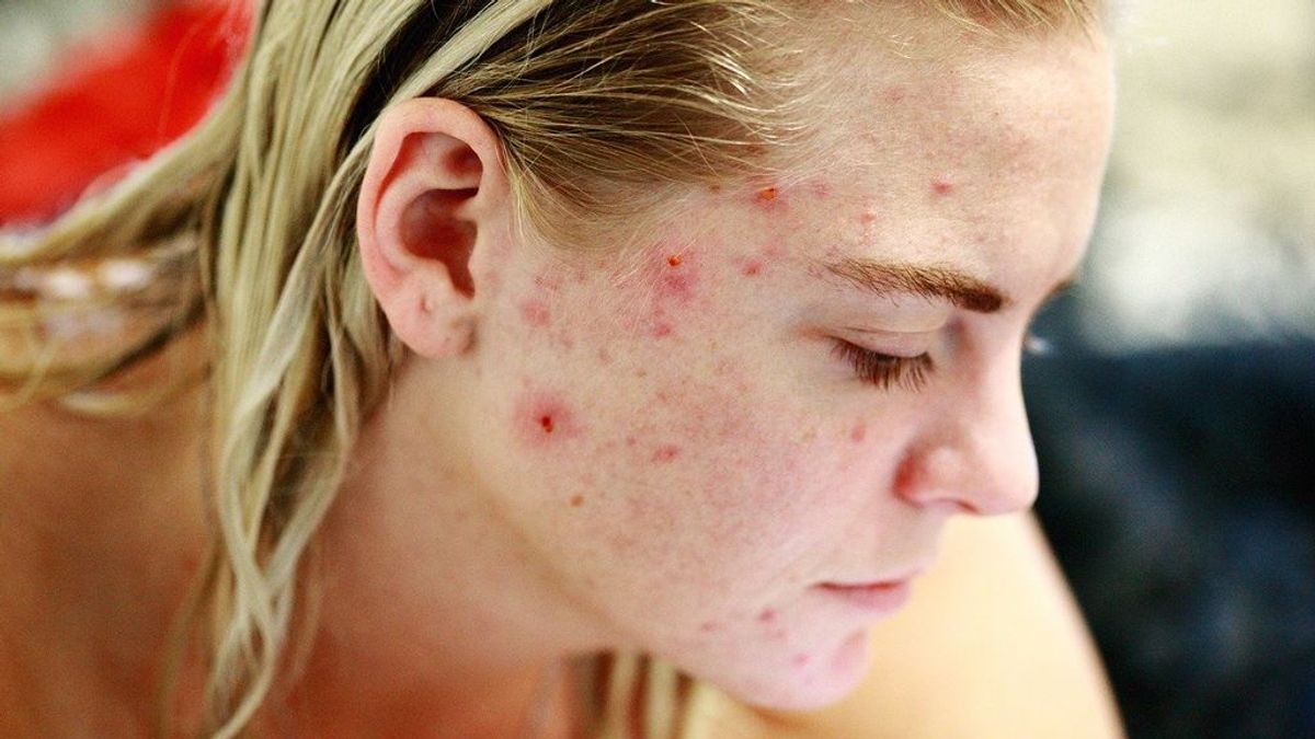 Las mascarillas rescatan el acné, la enfermedad cutánea de la adolescencia