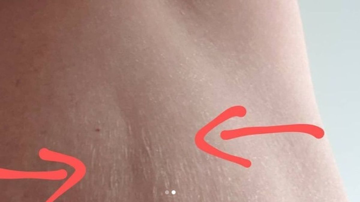Una mujer comparte la fotografía de una 'estría' en su escote por la que descubrió que tenía cáncer de mama