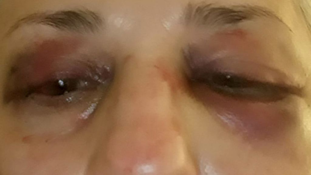 Así le dejaron la cara a la farmacéutica agredida en Argüelles (Madrid). Así le dejaron la cara a la farmacéutica agredida en Argüelles (Madrid).