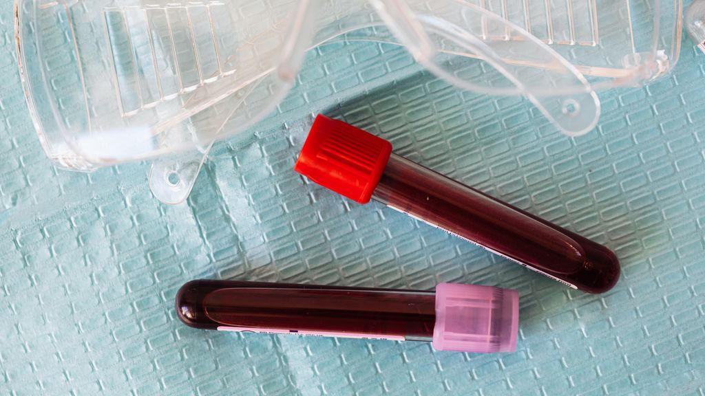 Hemocromatosis en la menopausia: ¿Qué es y cuáles son las causas?