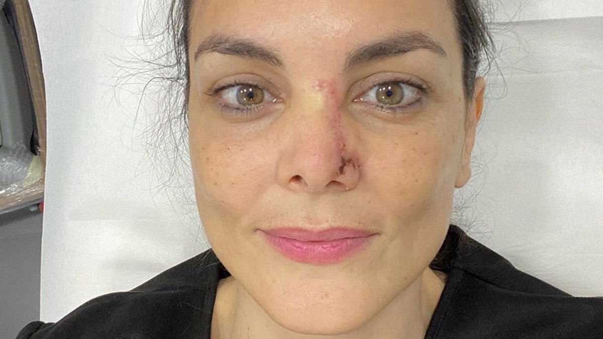 Mónica Carrillo confiesa que le han detectado cáncer de piel en la nariz: "En ocasiones la vida nos da zarpazos"