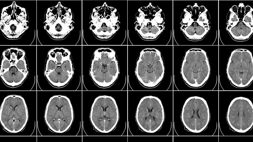 Encefalopatías, encefalitis y patologías neurovasculares: las dolencias neurológicas más comunes de la Covid-19 Encefalopatías, encefalitis y patologías neurovasculares: las dolencias neurológicas más comunes de la Covid-19