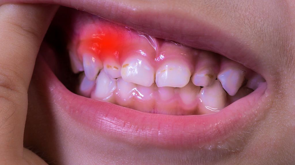 El niño podrá tener una gingivitis provocado por un cambio hormonal o por un antibiótico.