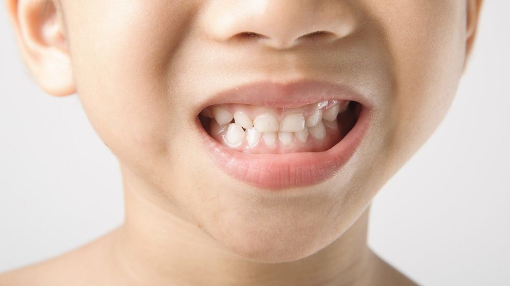 La gingivitis estará provocada por una mala limpieza de la boca, entre otros problemas.