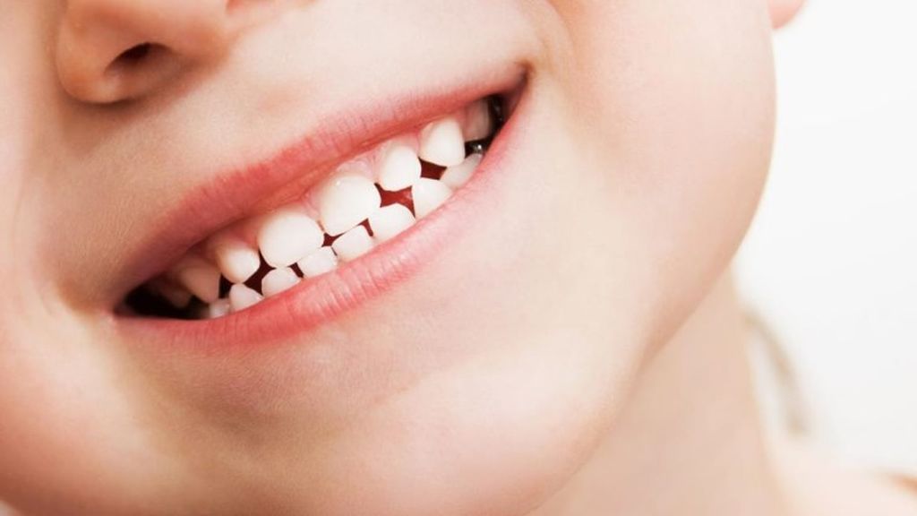 Gingivitis en niños, causas y tratamientos.