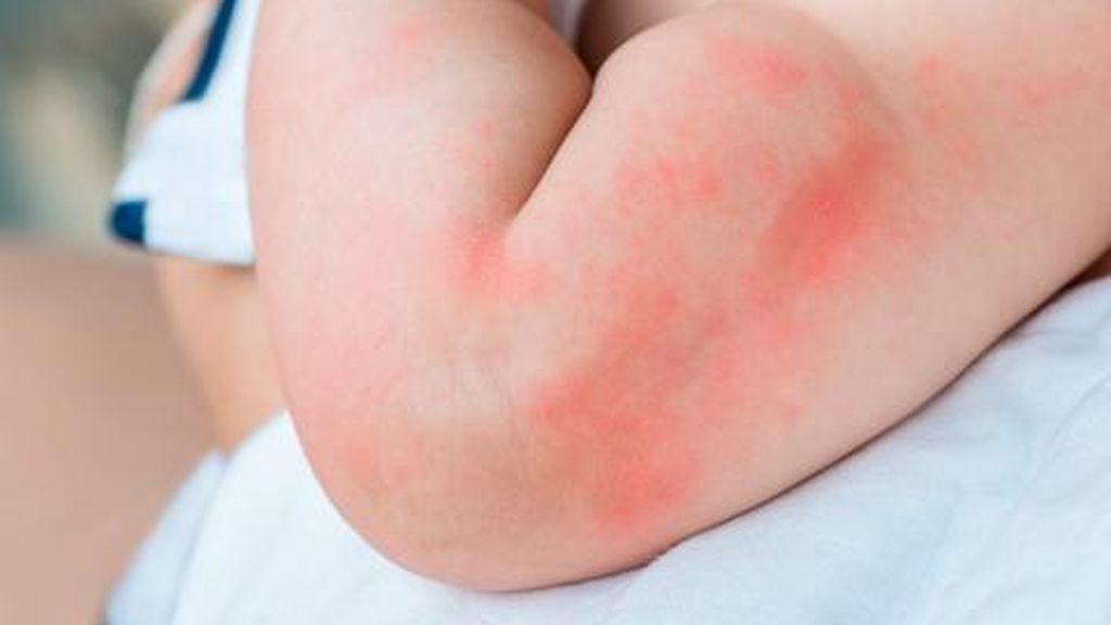 Si no se lleva a cabo una buena higiene e hidratación de la piel es muy probable que aparezca la dermatitis.