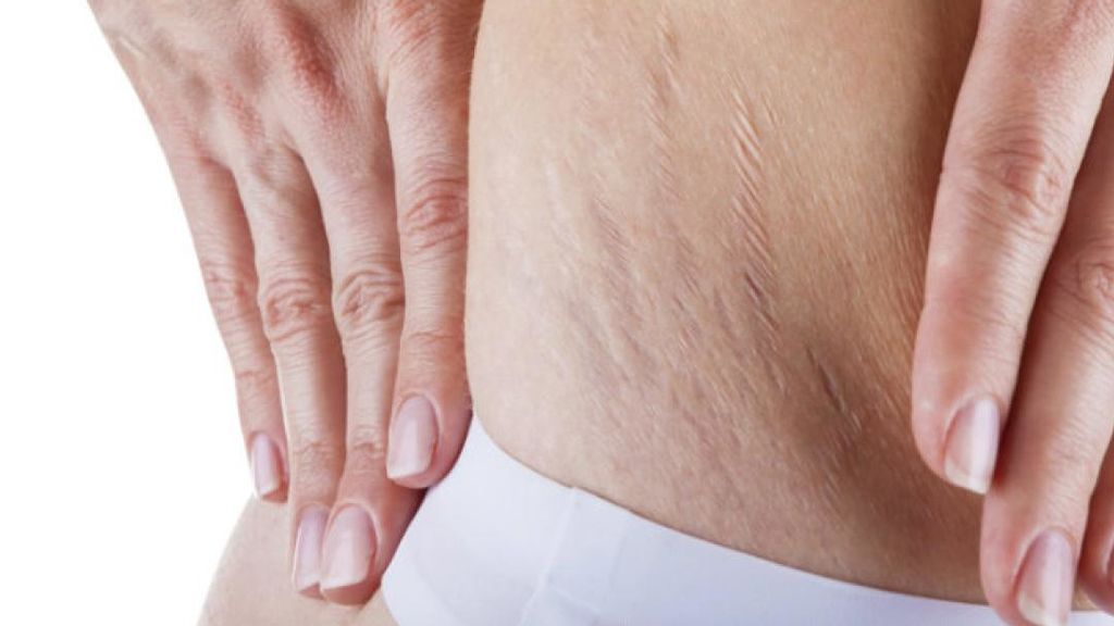 Este será ideal para el cuerpo, ya que prevendrá la aparición de estrias.
