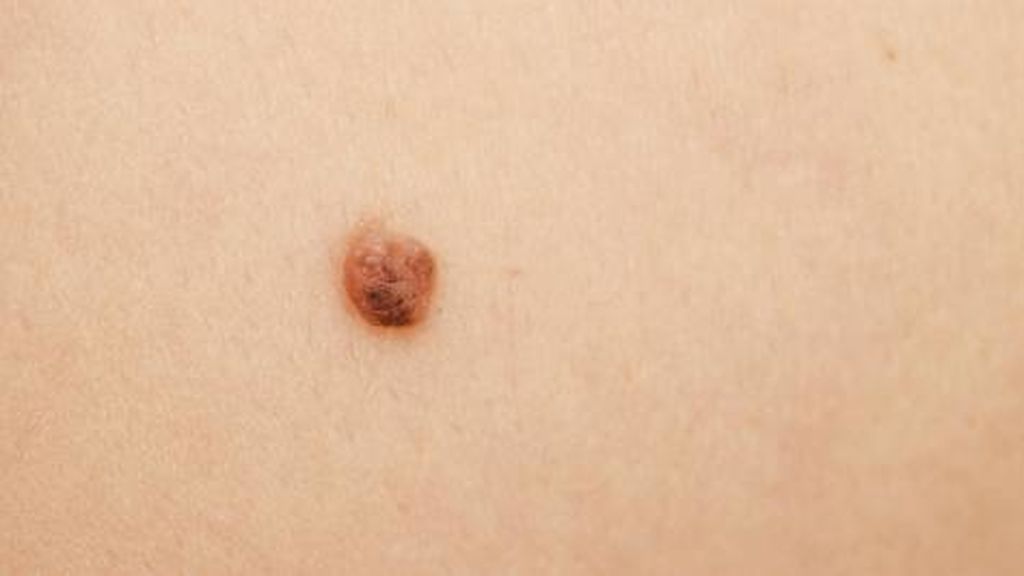 En la piel, nos podemos encontrar tres tipos de cáncer; carcinoma basocelular, carcinoma de células escamosas y melanoma maligno.