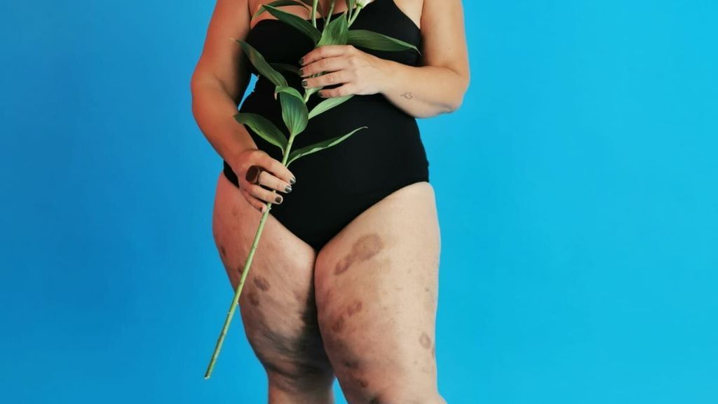 Qué es la enfermedad Lipedema que afecta al 20 % de las mujeres