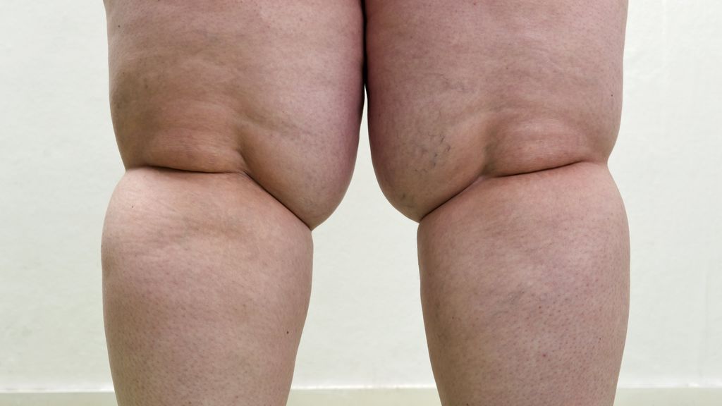 ¿Qué es el lipedema? Aprende a identificarlo y qué tratamientos existen