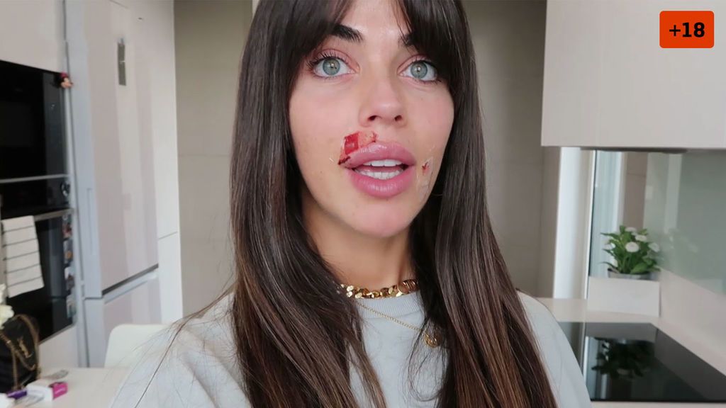 Violeta muestra las secuelas que ha sufrido en la cara tras quitarse la marca de un piercing (1/2)