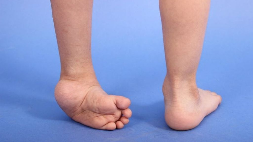 Pie varo es una malformación que se produce cuando el pie se curva hacia adentro.