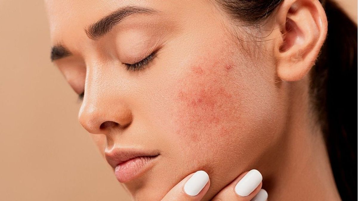 Granos y otras lesiones en la piel de la cara:  consejos para prevenirlos y tratarlos