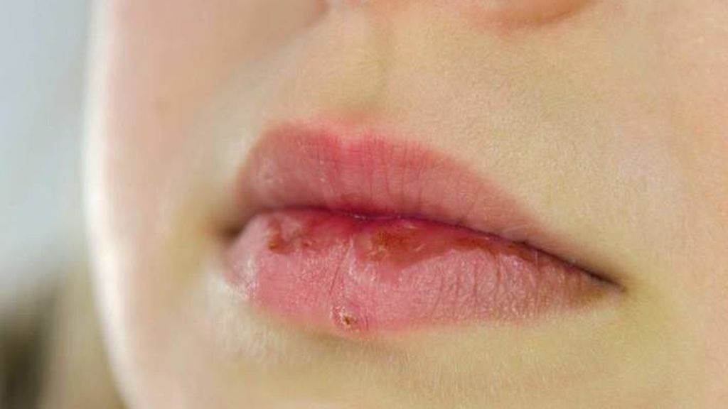 herpes-labial-pixabay