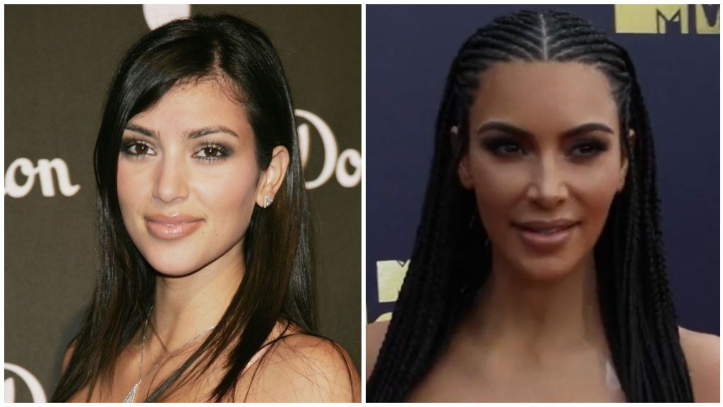 Muchos famosos han sucumbido a los encantos de esta intervención, como Kim Kardashian.