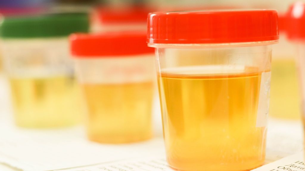 ¿Qué problemas esconde la hematuria o sangre en la orina?