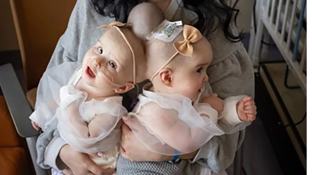 Separan a dos siamesas de 9 meses unidas por la cabeza:  una "cirugía histórica" con más de 30 profesionales