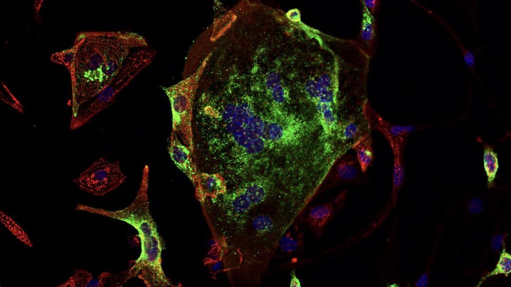 Muerte súbita por covid: el coronavirus puede atacar directamente las células del corazón y matar en minutos