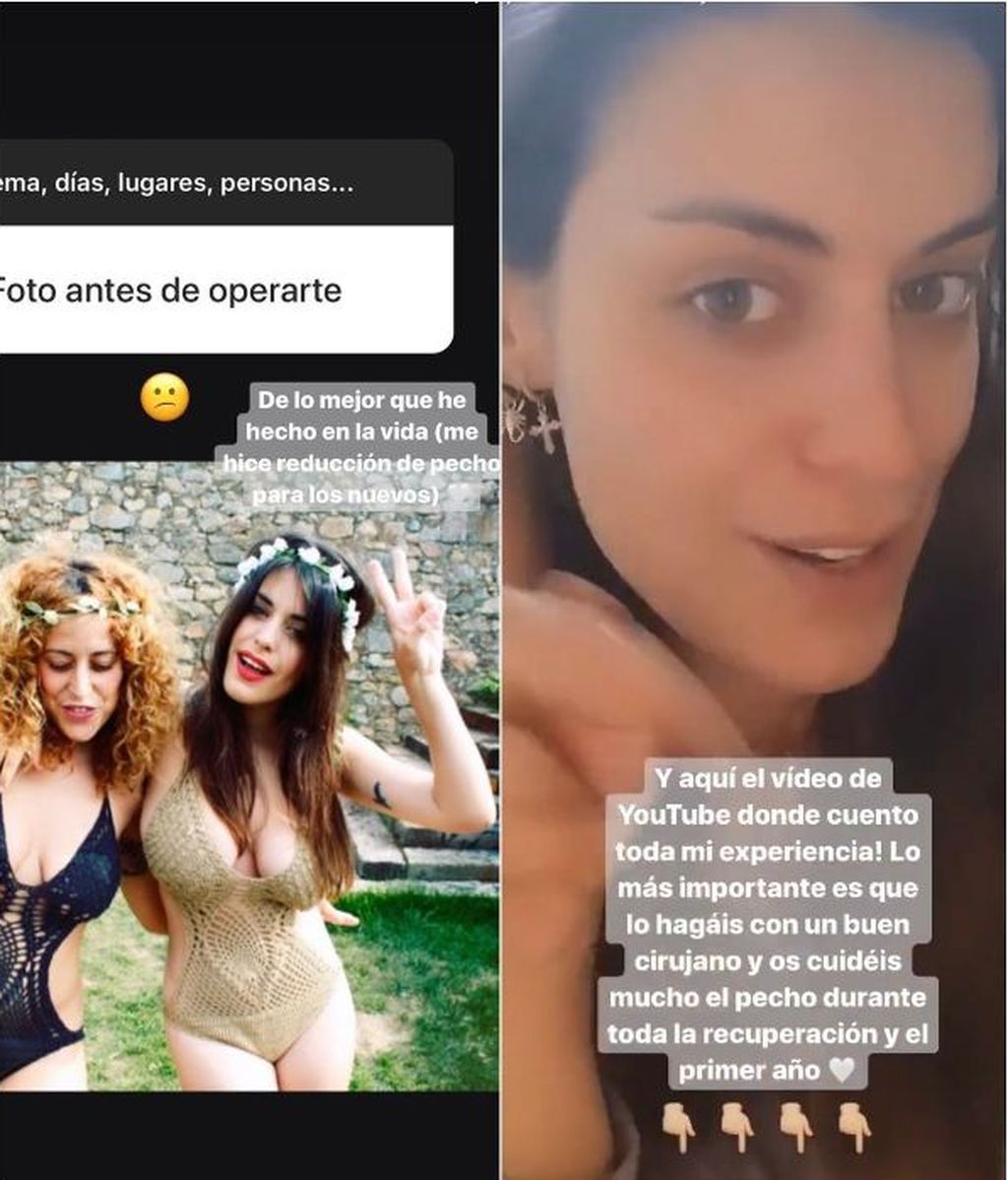 Dulceida muestra el antes de su reducción de pecho