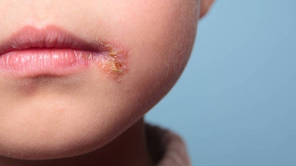 El herpes labial en niños es más común de lo que pensamos: qué es y cómo tratarlo.