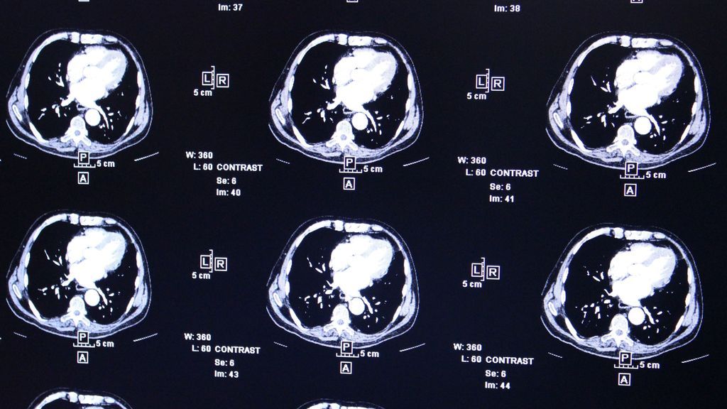 Luces y sombras del 'aducanumab', el medicamento que podría frenar el Alzheimer