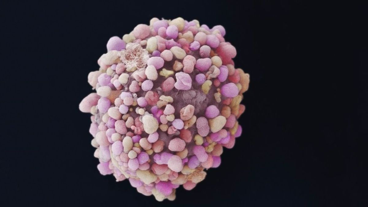 Identifican una proteína detrás del las causas de la metástasis en cáncer de mama Identifican una proteína detrás del las causas de la metástasis en cáncer de mama