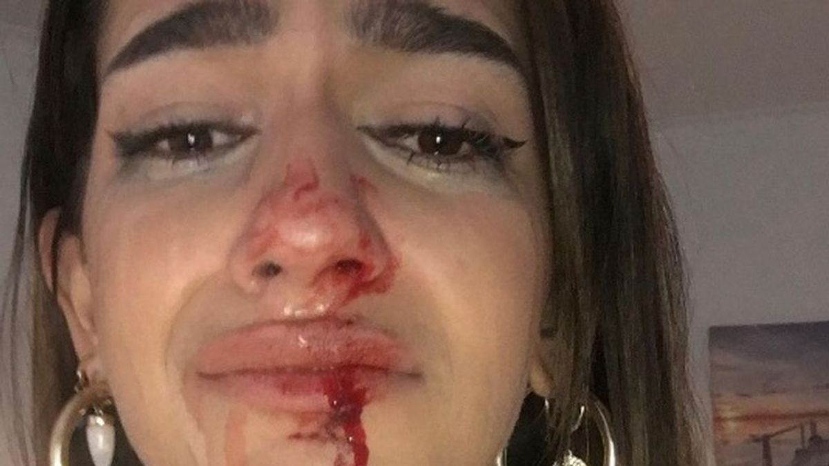 Eva, una joven transexual denuncia una brutal agresión al grito de "‘¡puto travelo! ¡engendro!" en Barcelona