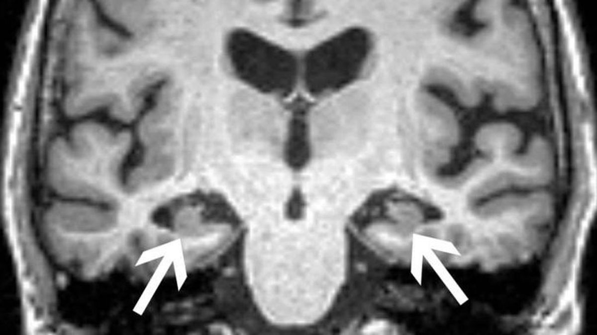 EuropaPress_3447131_resonancia_magnetica_cerebro_mujer_72_anos_muestra_perdida_volumen EuropaPress_3447131_resonancia_magnetica_cerebro_mujer_72_anos_muestra_perdida_volumen