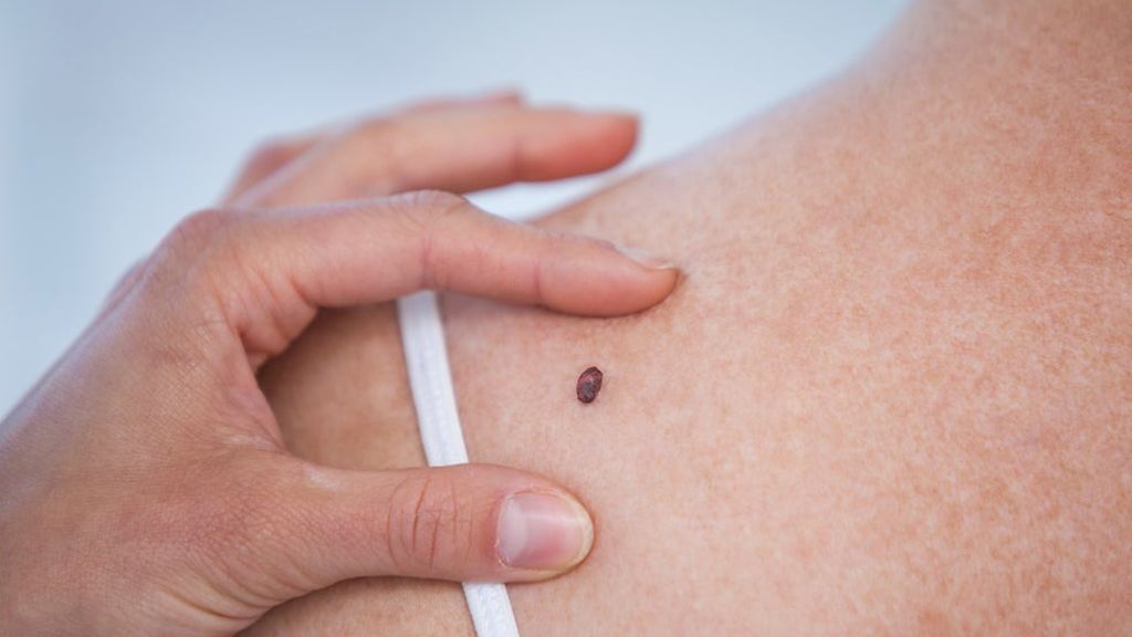 Para prevenir esta complicación, lo más recomendable será no estar demasiado expuesto al sol.