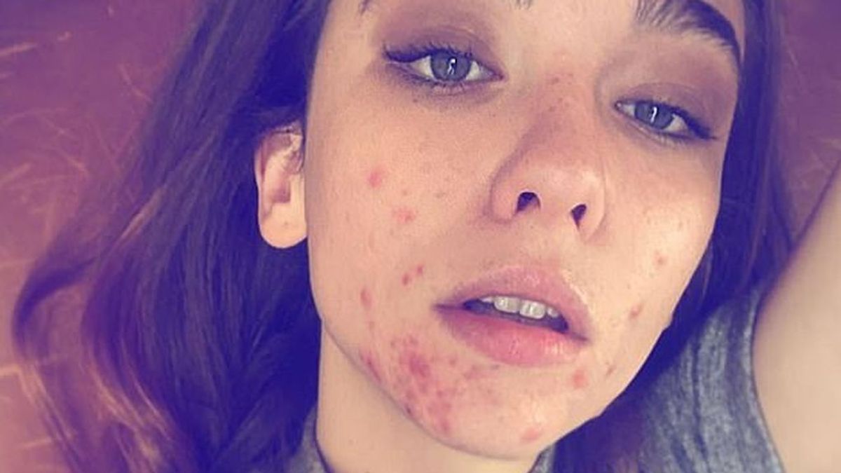 La actriz Matilda de Angelis ('The Undoing') publica una foto de su rostro "devorado por el acné"