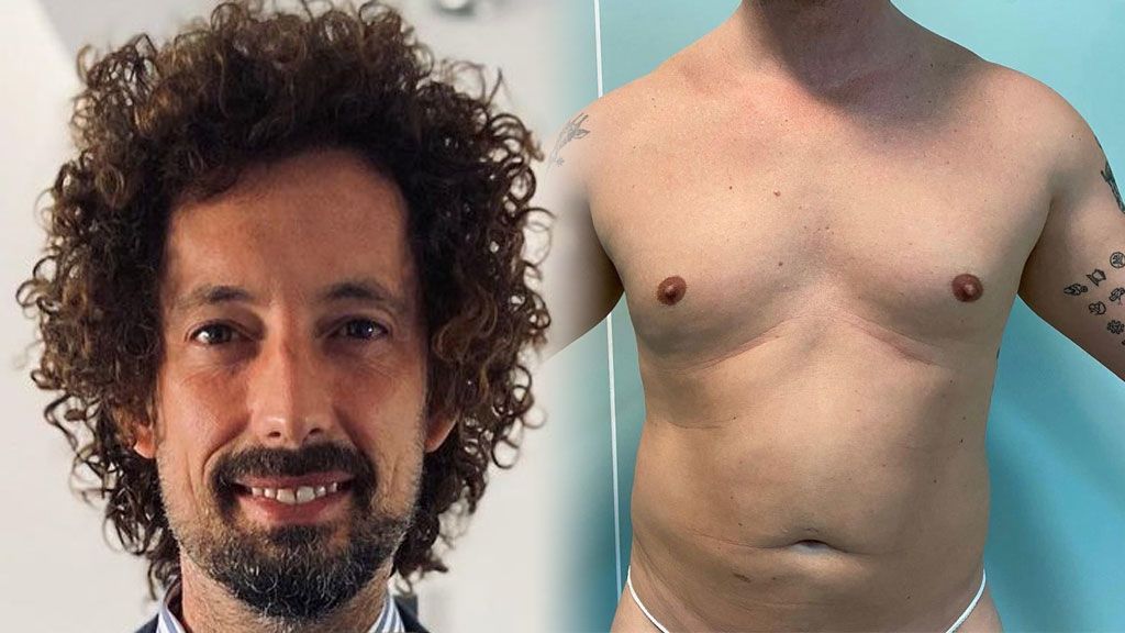 El asombroso antes y después de José Antonio León tras someterse a una liposucción