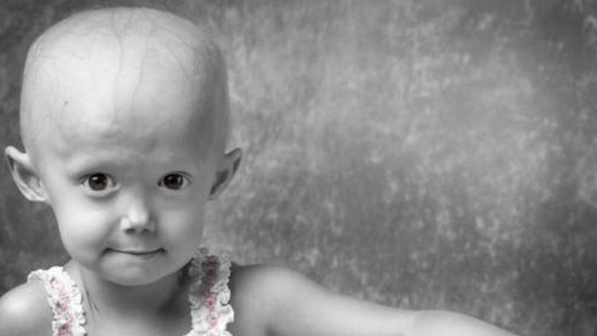 Vivir con progeria, la enfermedad rara que provoca envejecimiento prematuro