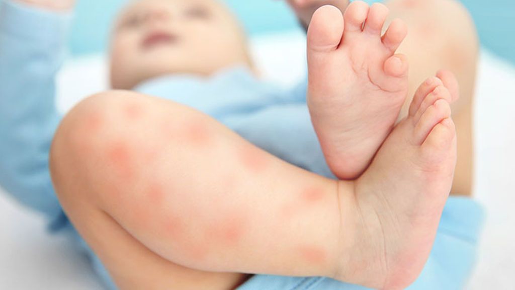La dermatitis atópica puede ser bastante molesta para el pequeño.