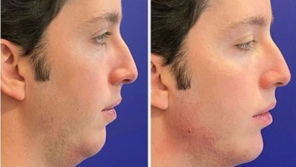 El antes y después del Pequeño Nicolás