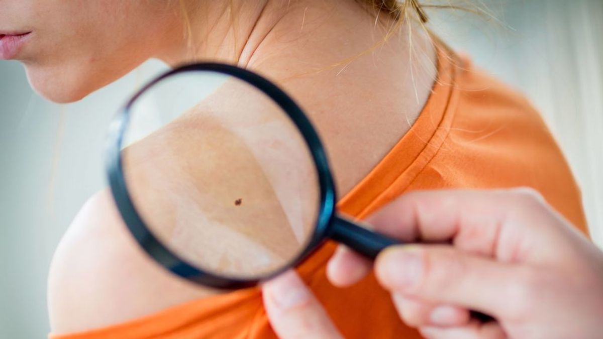 Lunares en la piel: señales para saber cuándo debes acudir a un dermatólogo