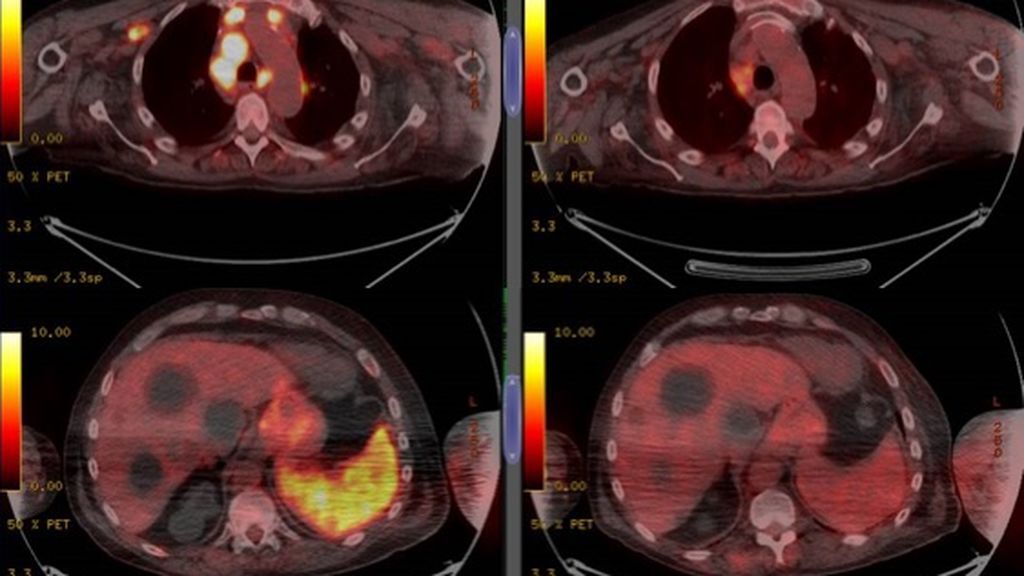 El extraño caso del hombre que se contagió de coronavirus y se curó de un cáncer El extraño caso del hombre que se contagió de coronavirus y se curó de un cáncer