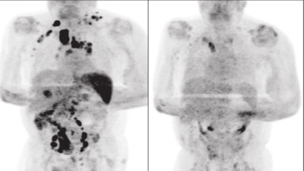 Comparativa en la tomagrafía del paciente antes y después de contagiarse por coronavirus