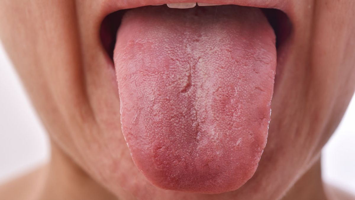 Descubren que la lengua aumentada o 'lengua covid' es un síntoma de coronavirus Descubren que la lengua aumentada o 'lengua covid' es un síntoma de coronavirus