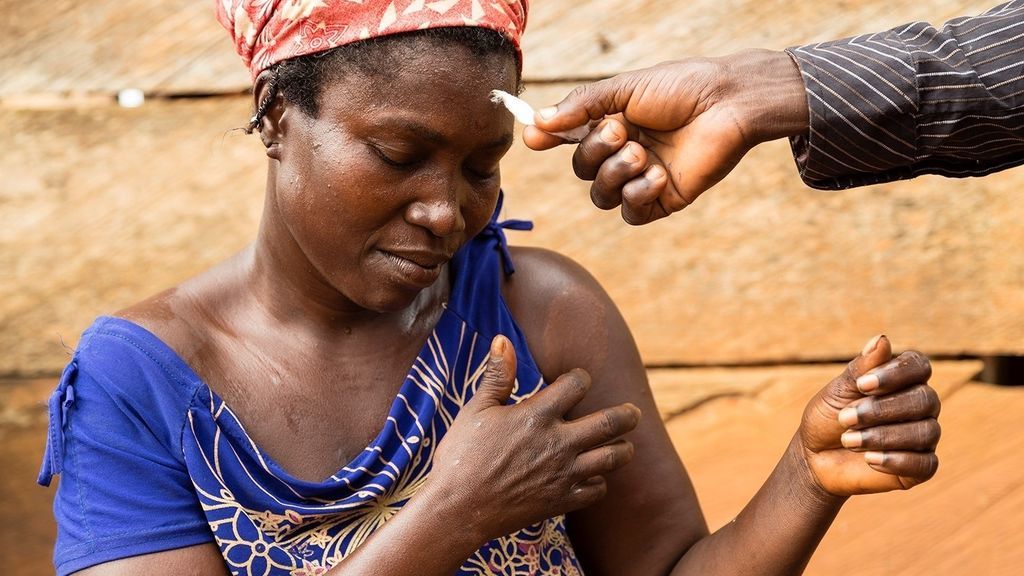 Cada año se diagnostican 200.000 casos nuevos de lepra en el mundo según la OMS Cada año se diagnostican 200.000 casos nuevos de lepra en el mundo según la OMS