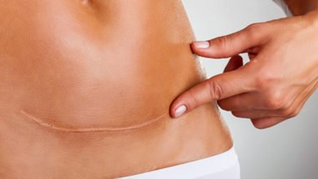 5 consejos para cuidar la cicatriz de la cesarea: así podrás evitar que la herida se abra o se infecte.